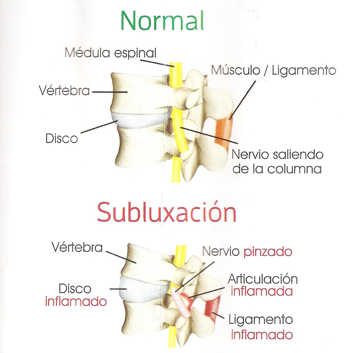 Subluxación vertebral